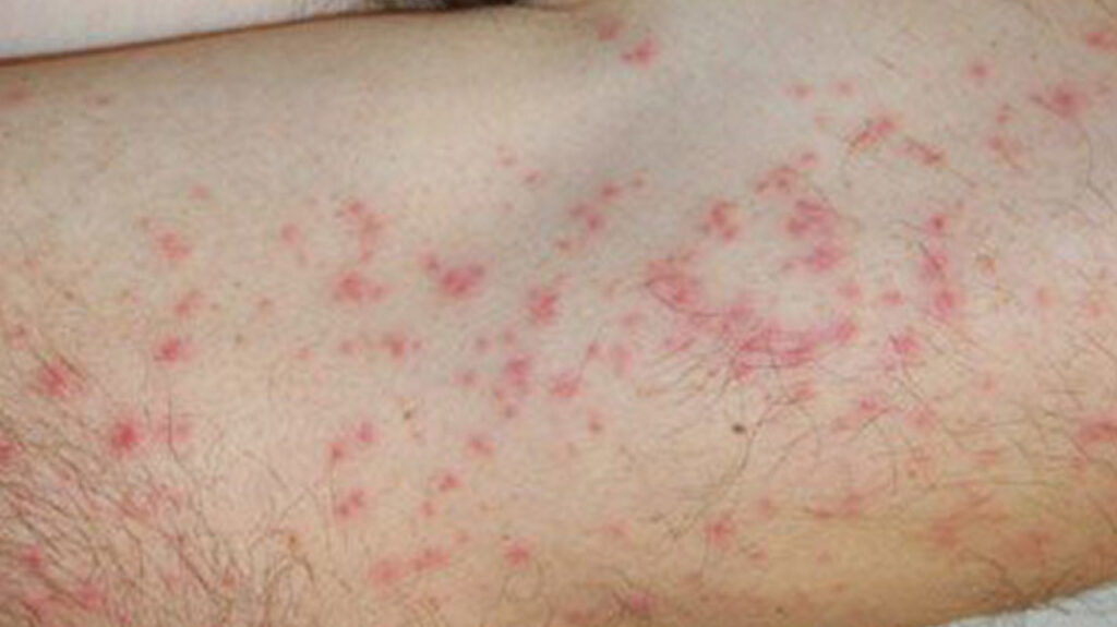 red-spots-on-skin-causes-symptoms-and-remedies