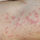 Red Spots On Skin: Causes, Symptoms and Remedies